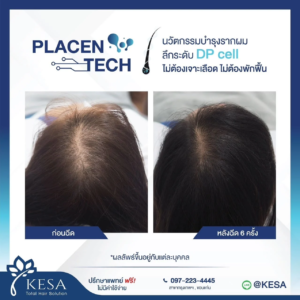 PLAZENTECH