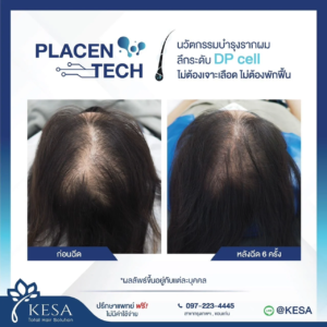 PLAZENTECH