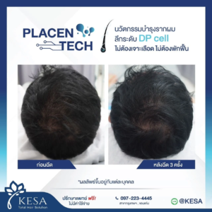 PLAZENTECH