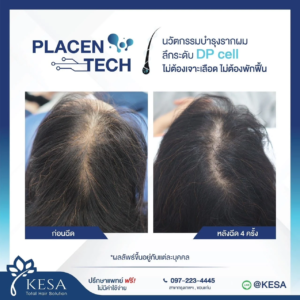 PLAZENTECH