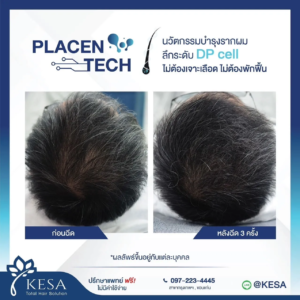 PLAZENTECH