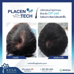 PLAZENTECH