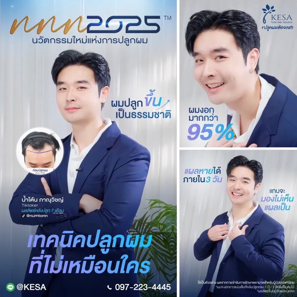 ปลูกผมเทคนิค NNN