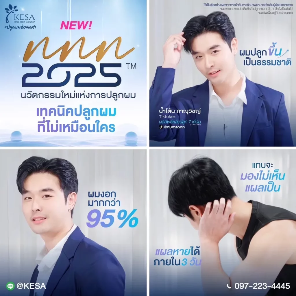 ปลูกผมเทคนิค NNN