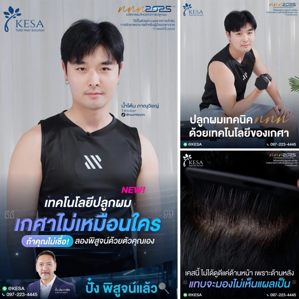 ปลูกผมเทคนิค NNN