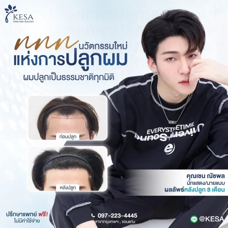 ปลูกผมผู้ชาย