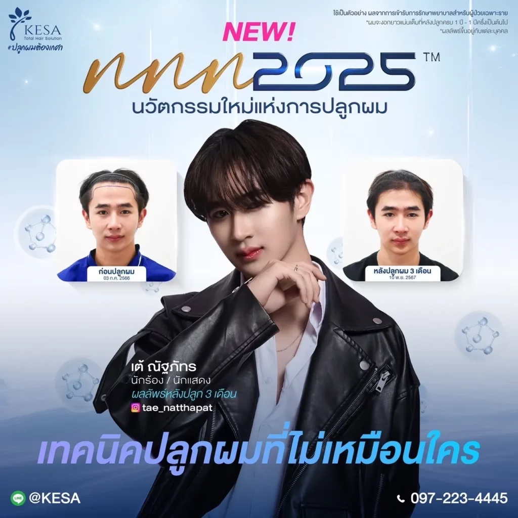 ปลูกผมเทคนิค NNN