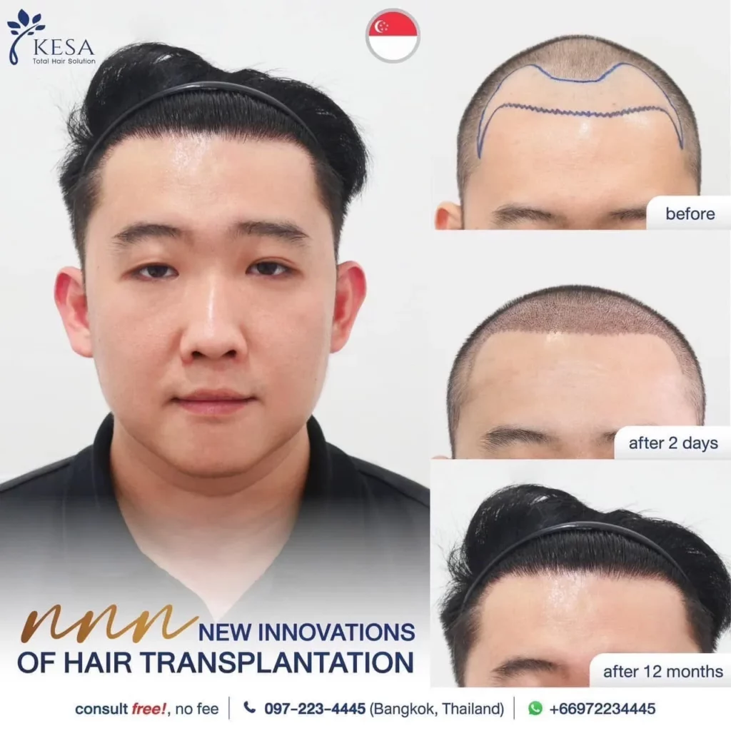 ปลูกผมเทคนิค NNN