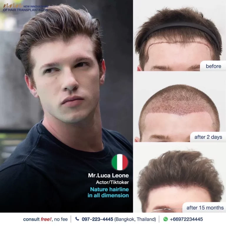 Male hair transplant