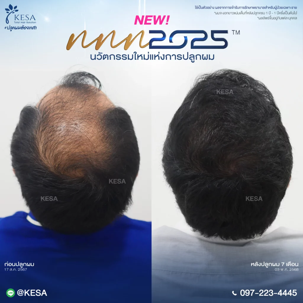 หัวล้านปลูกผมได้ไหม เกศา คลินิก - kesa hair clinic