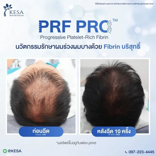 Review PRF PRO เกศา คลินิก - kesa hair clinic เกศา คลินิก - kesa hair clinic