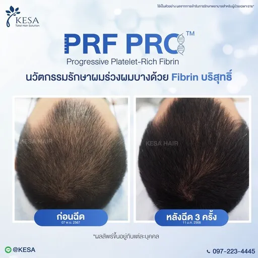 Review PRF PRO