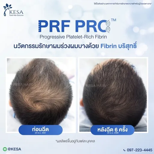 Review PRF PRO