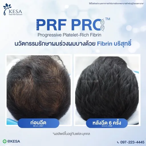 Review PRF PRO
