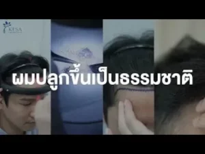 hqdefault – เกศา คลินิก - kesa hair clinic – เกศา คลินิก - kesa hair clinic ผมปลูกขึ้นเป็นธรรมชาติ เกศา คลินิก - kesa hair clinic เกศา คลินิก - kesa hair clinic