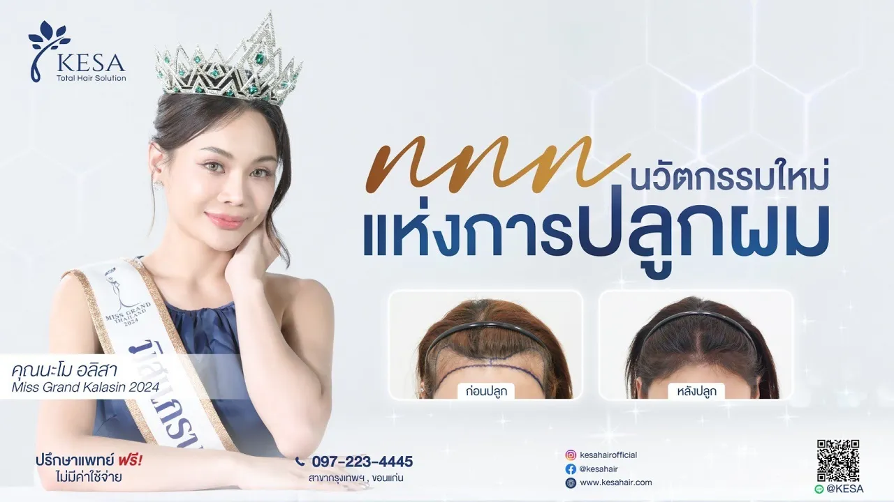 ปลูกผมผู้หญิง สร้างแนวผมแบบ NNN hairline ปรับกรอบหน้าละมุมน ผลลัพธ์ธรรมชาติ!