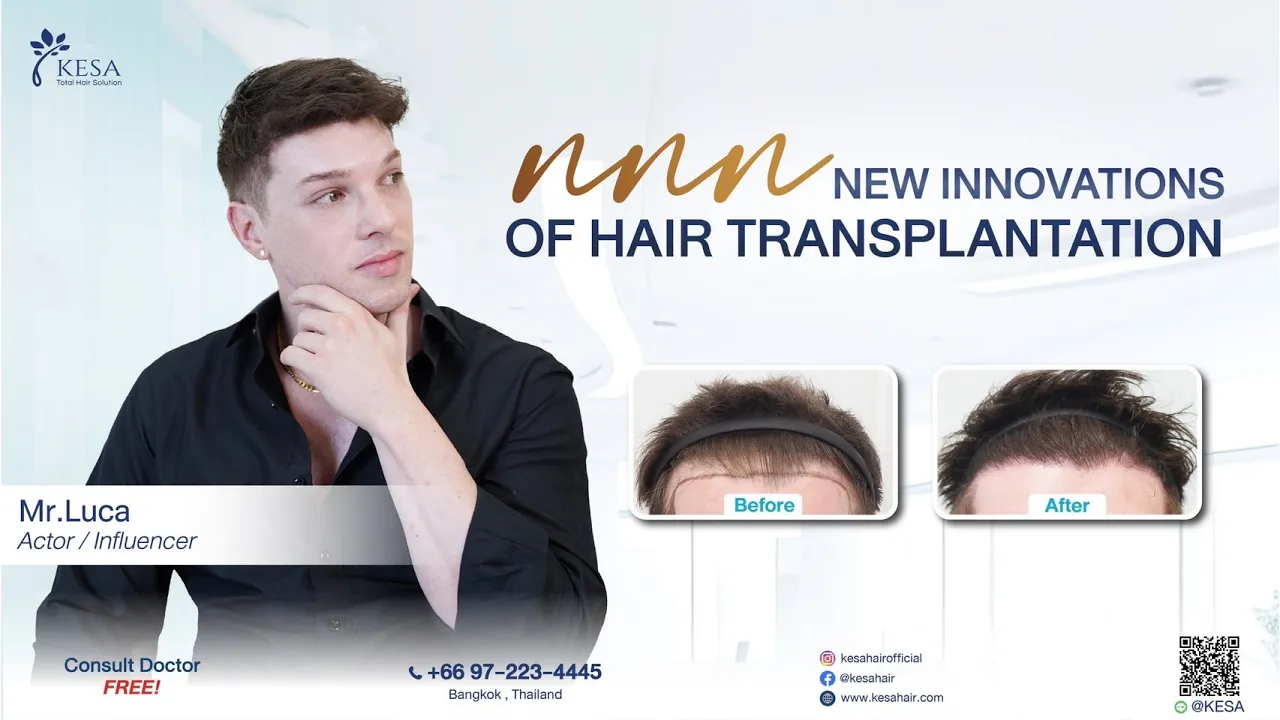 “Hair transplant in Bangkok” กับ Mr.Luca คนไข้ชาวอิตาลี บินตรงเพื่อมาปลูกผมกับเกศา!
