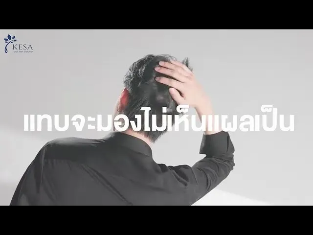 ผลลัพธ์หลังปลูกผมที่ “แทบจะมองไม่เห็นแผลเป็น” ต้องเทคนิคปลูกผม NNN นวัตกรรมใหม่แห่งการปลูกผม