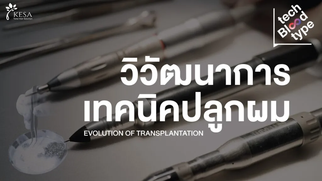 Tech Blood Type | วิวัฒนาการ เทคนิคปลูกผม