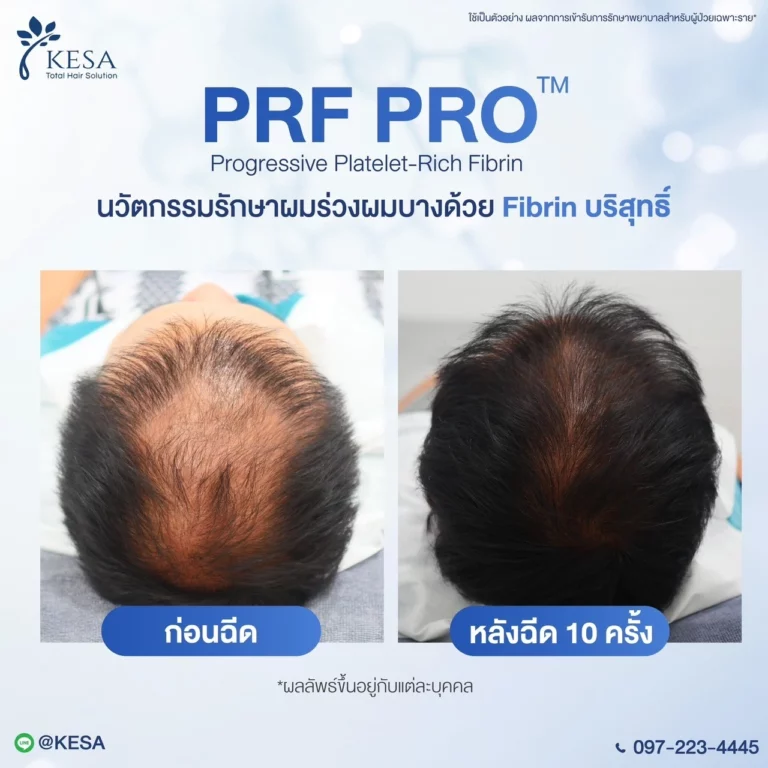 PRF เกศา คลินิก - kesa hair clinic
