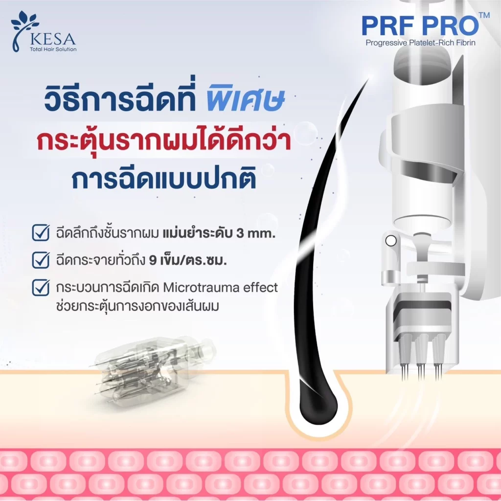 ฉีดบำรุง PRF เกศา คลินิก - kesa hair clinic