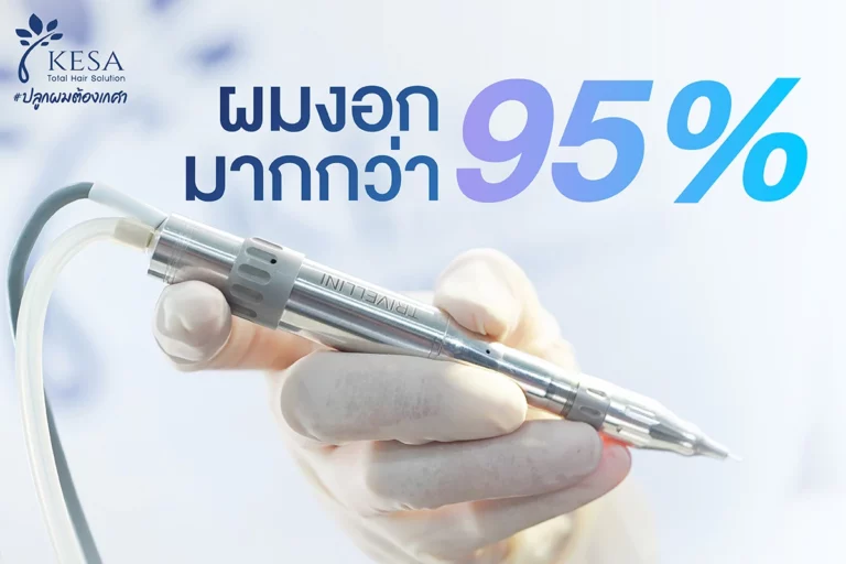 ผมงอกมากกว่า 95% เกศา คลินิก - kesa hair clinic