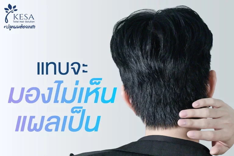 แทบจะมองไม่เห็นแผลป็น เกศา คลินิก - kesa hair clinic