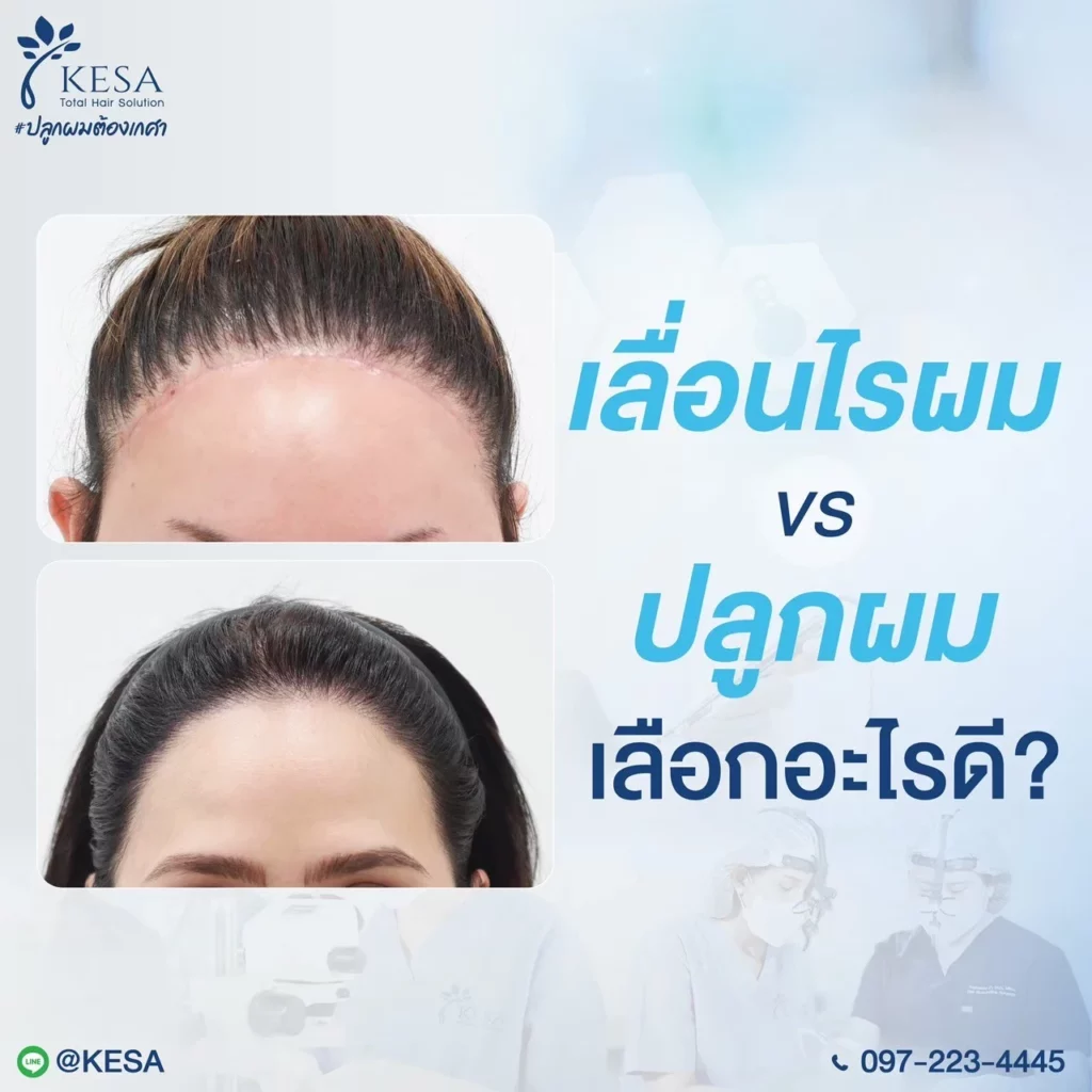 ผ่าตัดเลื่อนไรผม เกศา คลินิก - kesa hair clinic