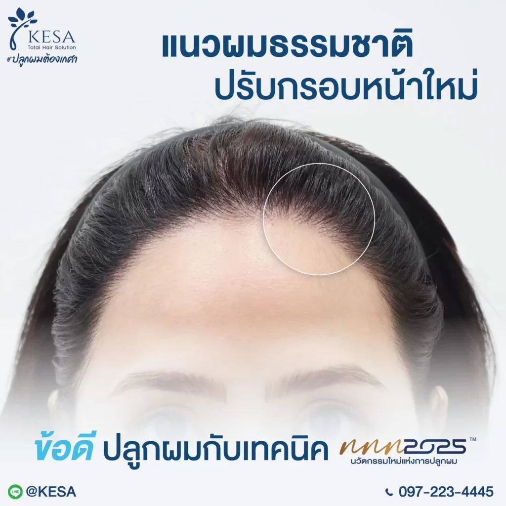 ปลูกผม หน้าผากกว้าง เกศา คลินิก - kesa hair clinic