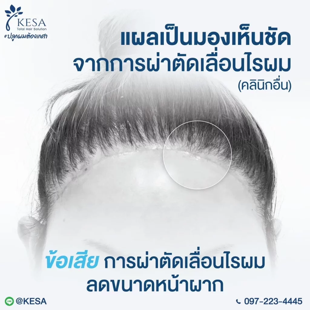 ผ่าตัดเลื่อนไรผม เกศา คลินิก - kesa hair clinic