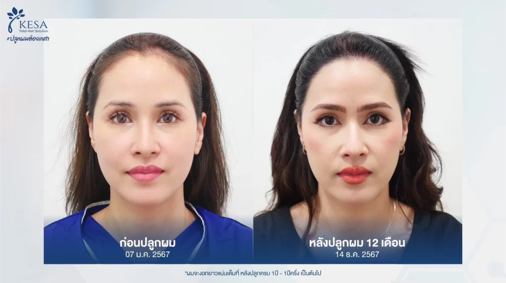 ปลูกผมปรับกรอบหน้า เกศา คลินิก - kesa hair clinic