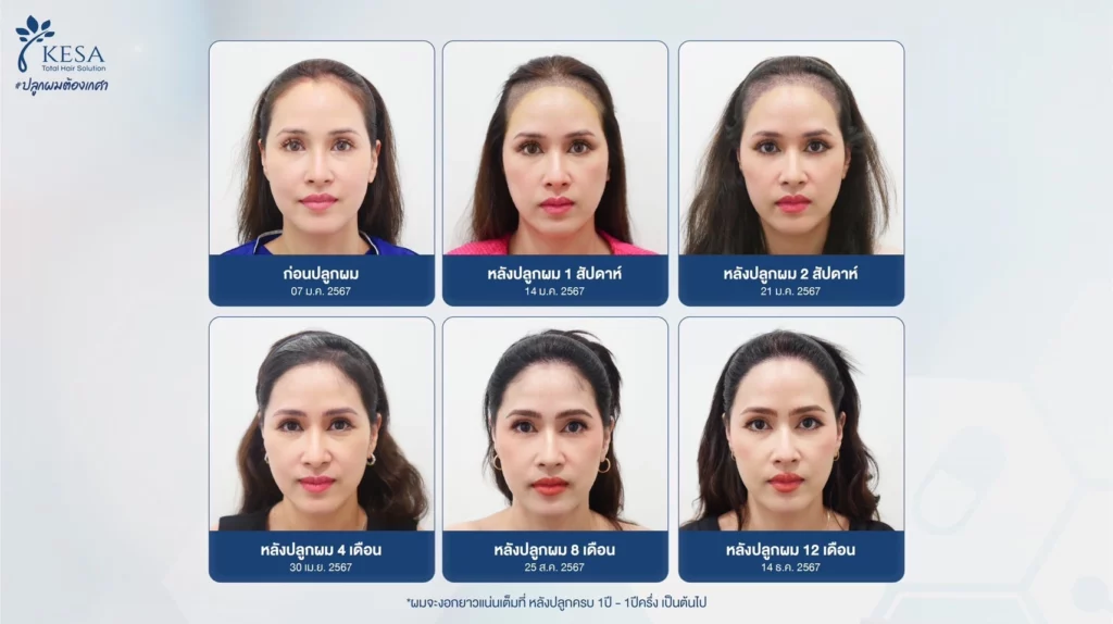 ปลูกผมผู้หญิง เกศา คลินิก - kesa hair clinic