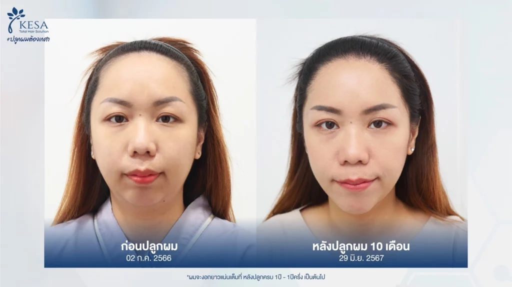 ปลูกผมผู้หญิง เกศา คลินิก - kesa hair clinic