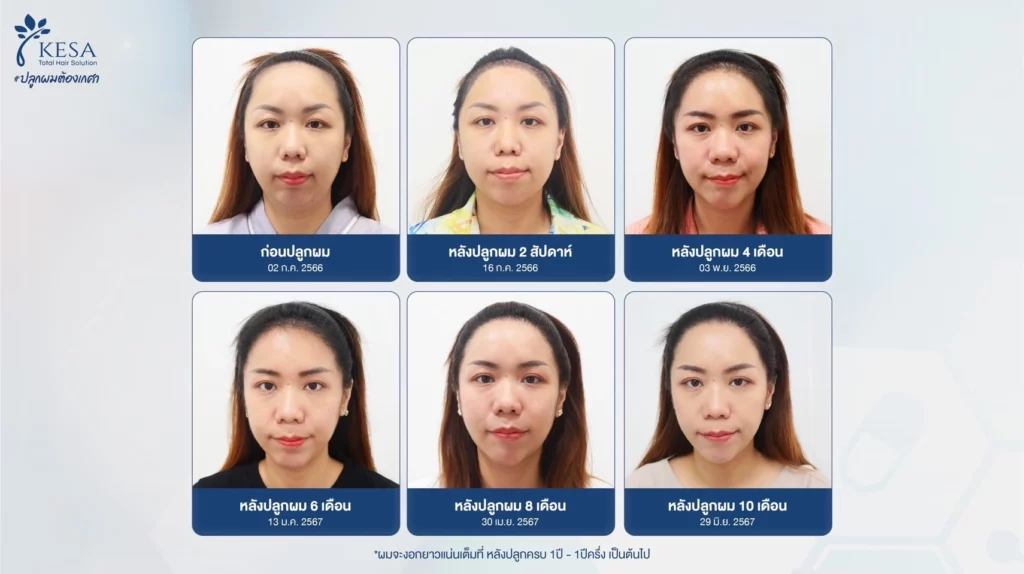 หน้าผากกว้าง ปลูกผมปรับกรอบหน้า เกศา คลินิก - kesa hair clinic