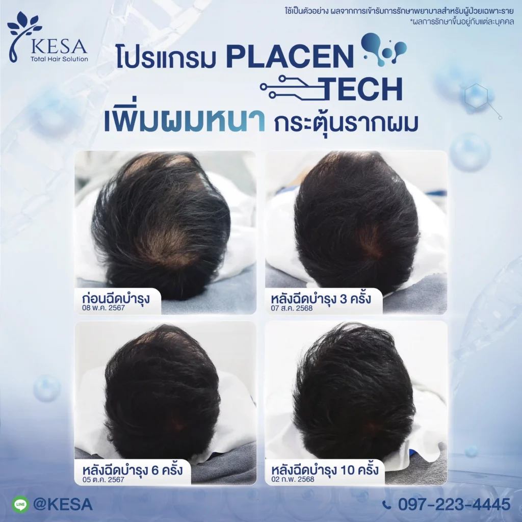 ฉีดบำรุงผมหนา Placentech เกศา คลินิก - kesa hair clinic