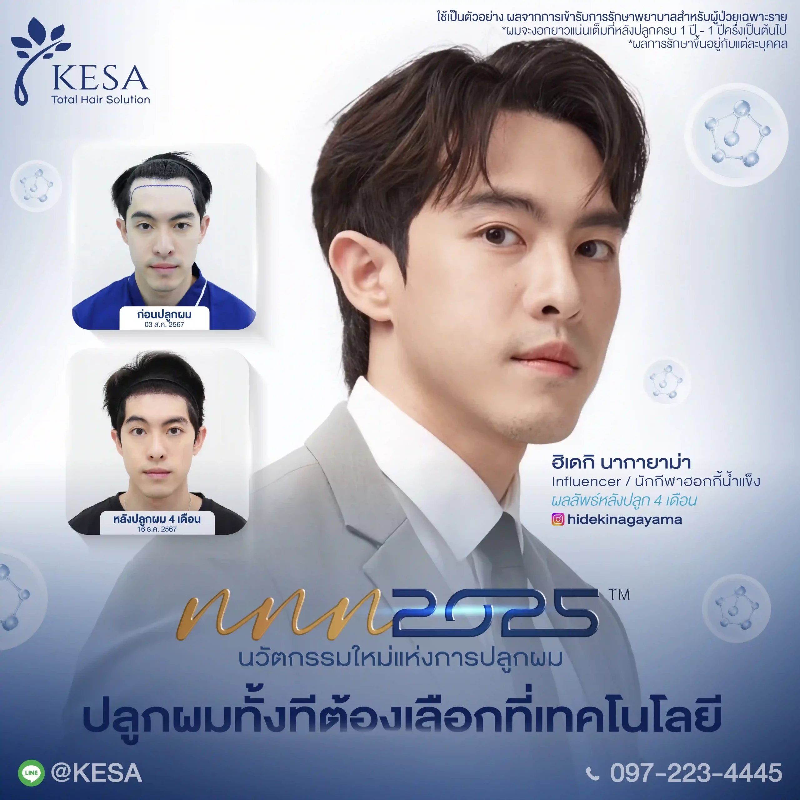 ปลูกผมที่ไหนดี 2025 สิ่งที่ต้องรู้ก่อนตัดสินใจเลือกคลินิกปลูกผม