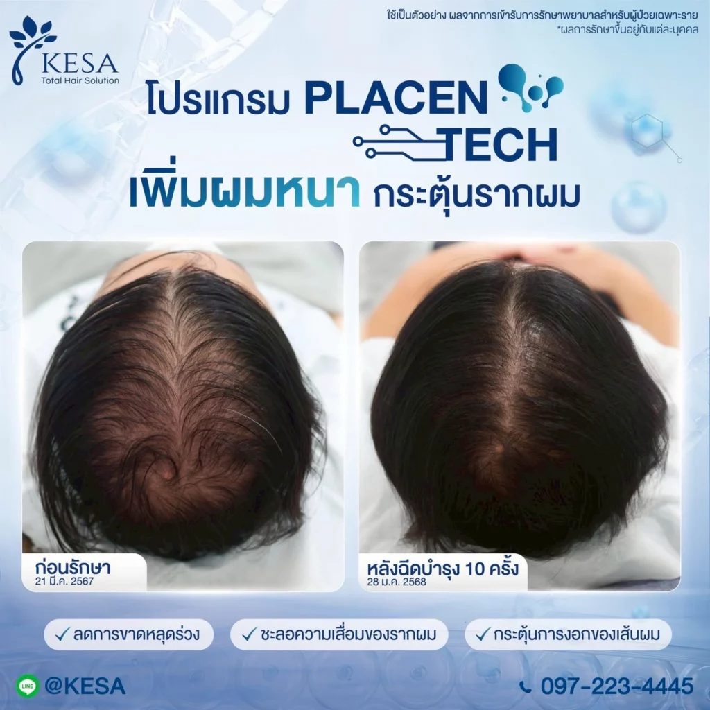placentech เกศา คลินิก - kesa hair clinic