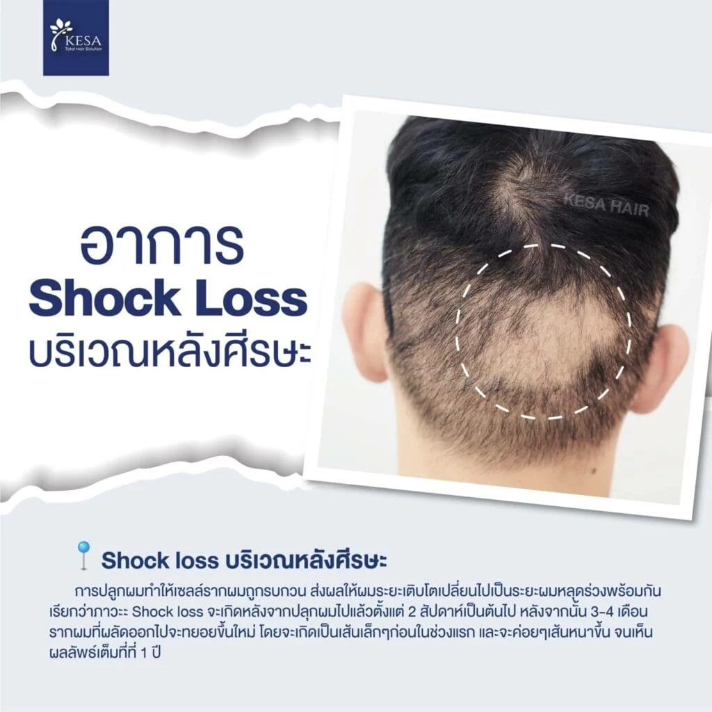 shock loss 1024×1024 เกศา คลินิก - kesa hair clinic