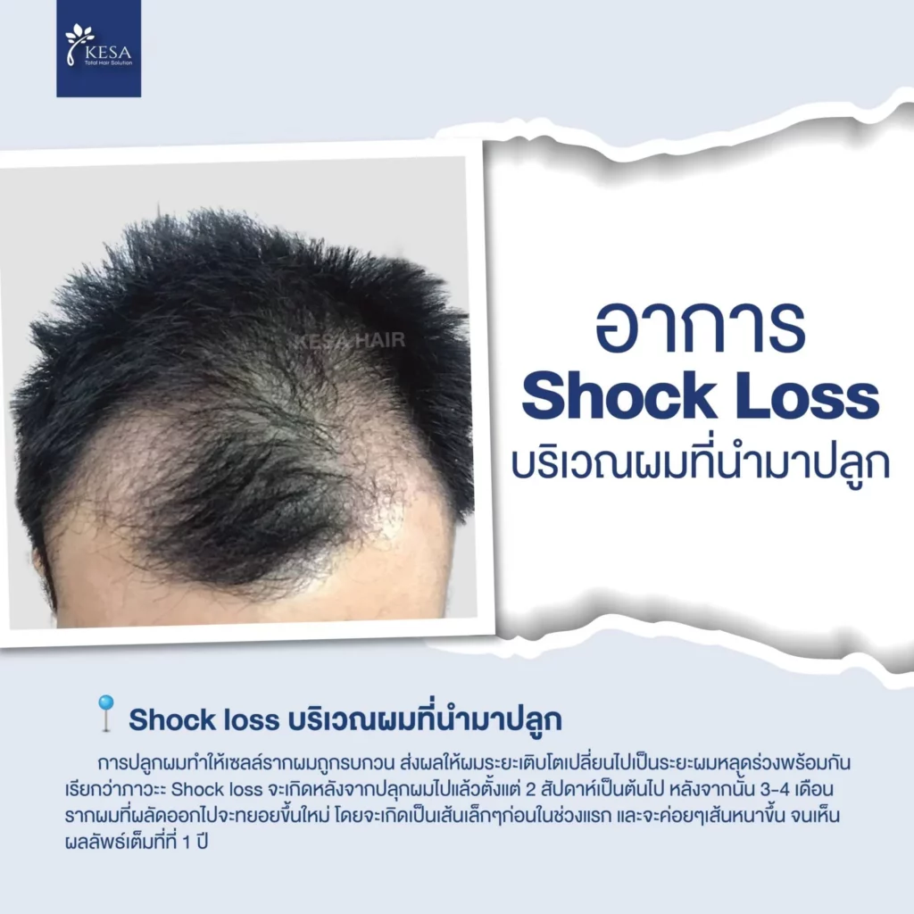 ปลูกผม 2 เดือน เกศา คลินิก - kesa hair clinic