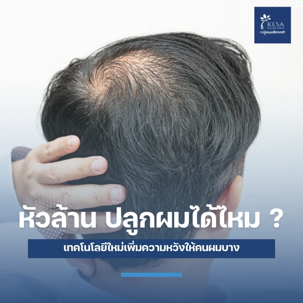 หัวล้าน ปลูกผมได้ไหม เกศา คลินิก - kesa hair clinic