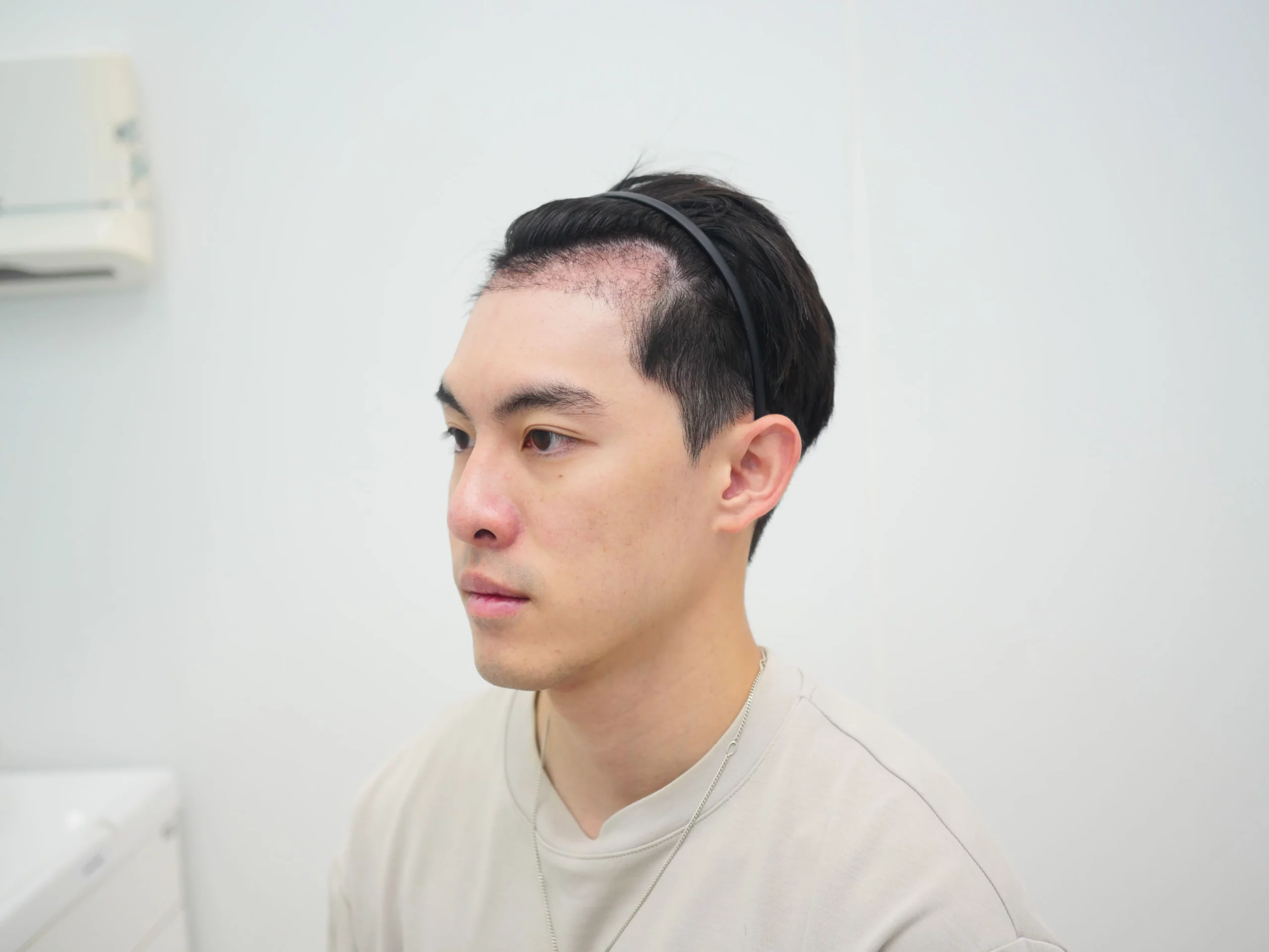 หลังปลูกผม 14 วัน เกศา คลินิก - kesa hair clinic