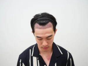หลังปลูกผม 3 วัน เกศา คลินิก - kesa hair clinic