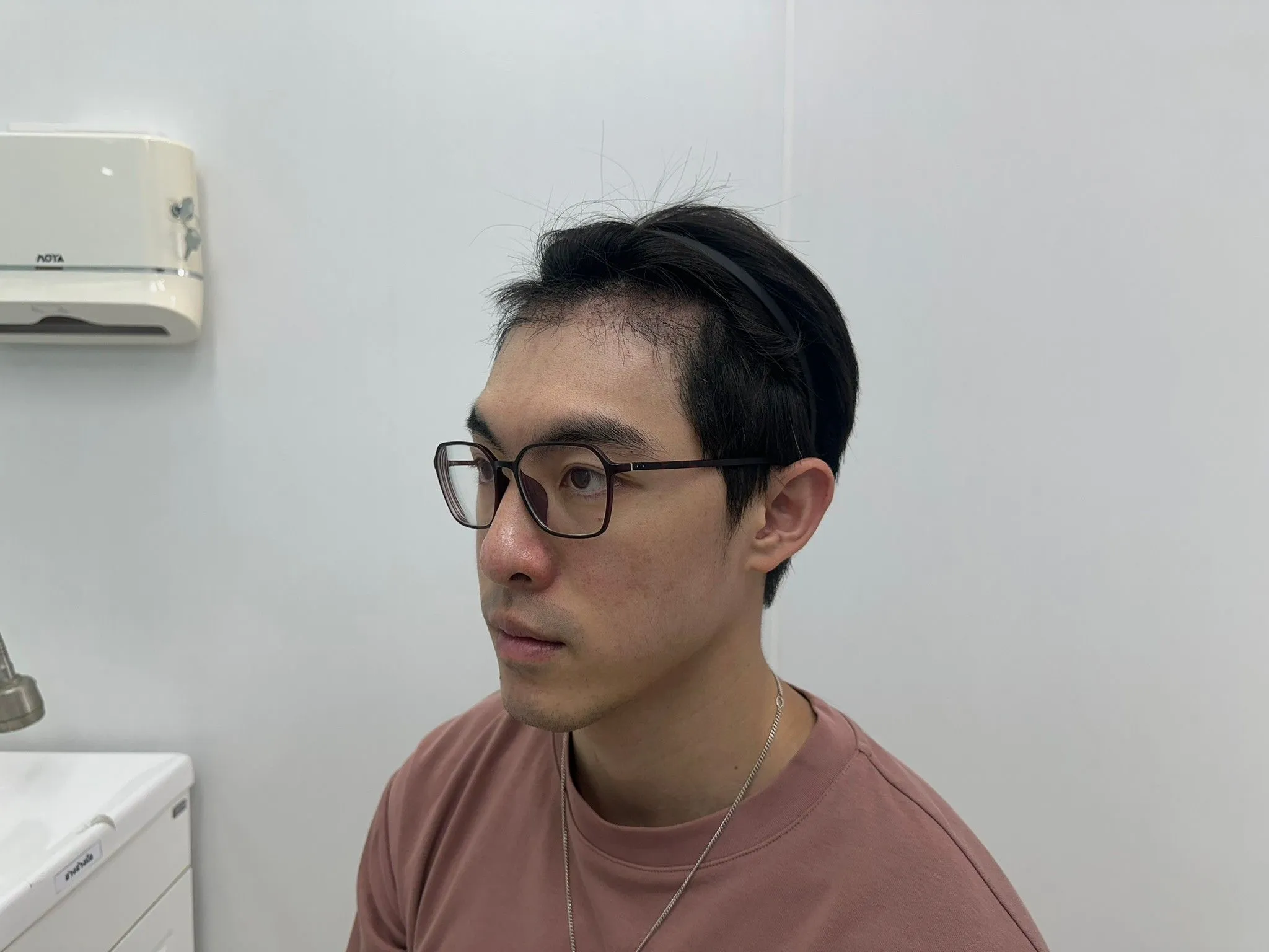 หลังปลูกผม 30 วัน เกศา คลินิก - kesa hair clinic