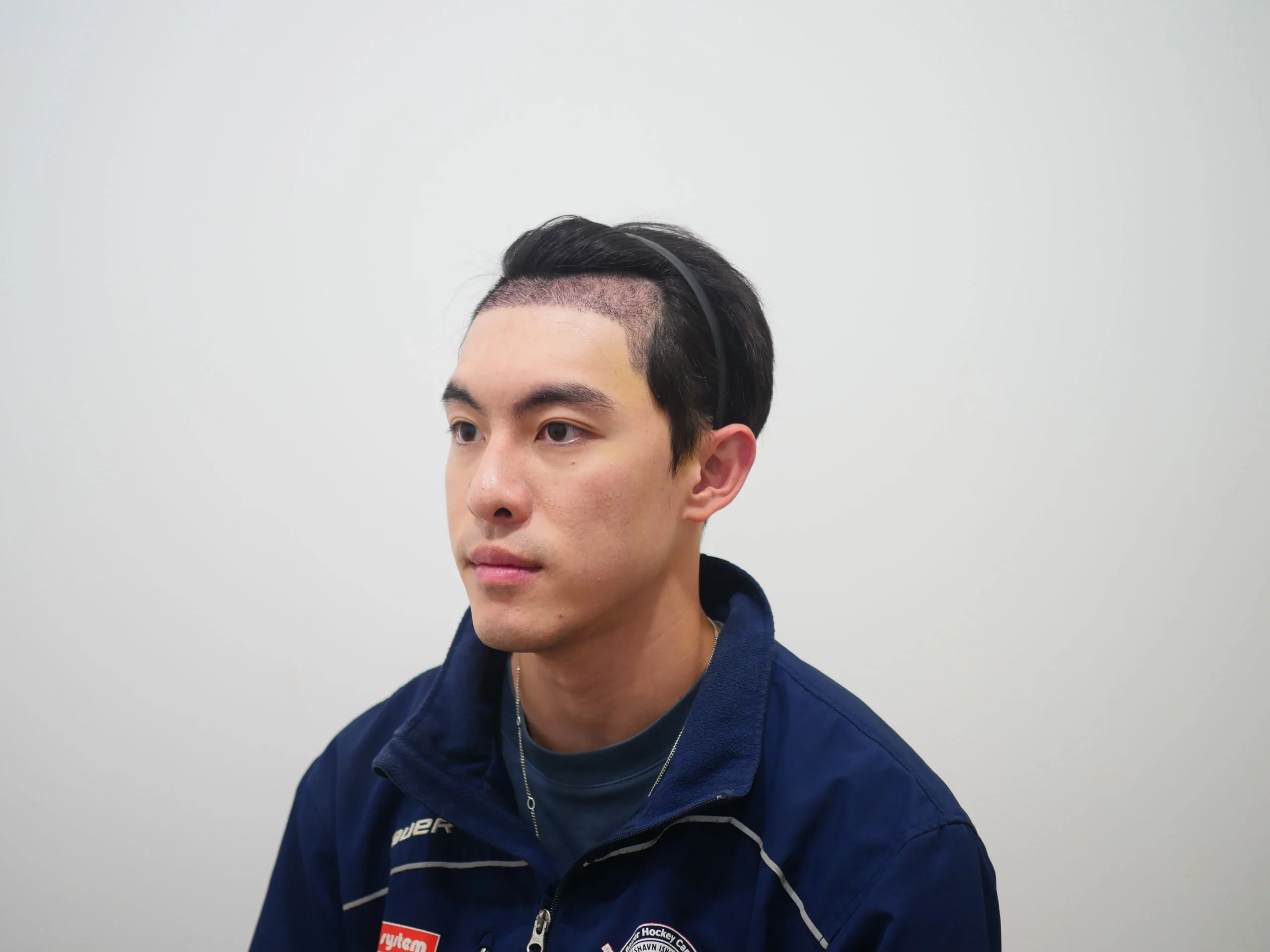 หลังปลูกผม 7 วัน เกศา คลินิก - kesa hair clinic