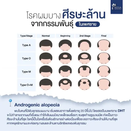 ผมร่วงบาง เกศา คลินิก - kesa hair clinic