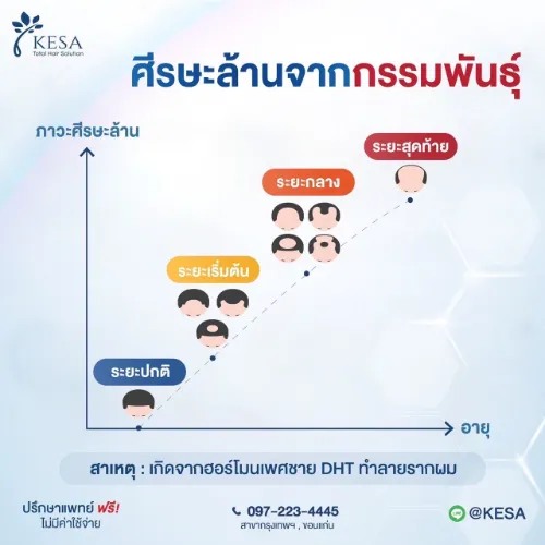 ผมบางกลางหัว