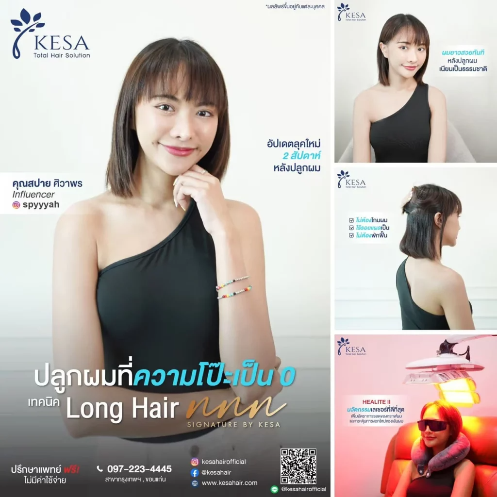 ปลูกผมแบบ Long hair เกศา คลินิก - kesa hair clinic