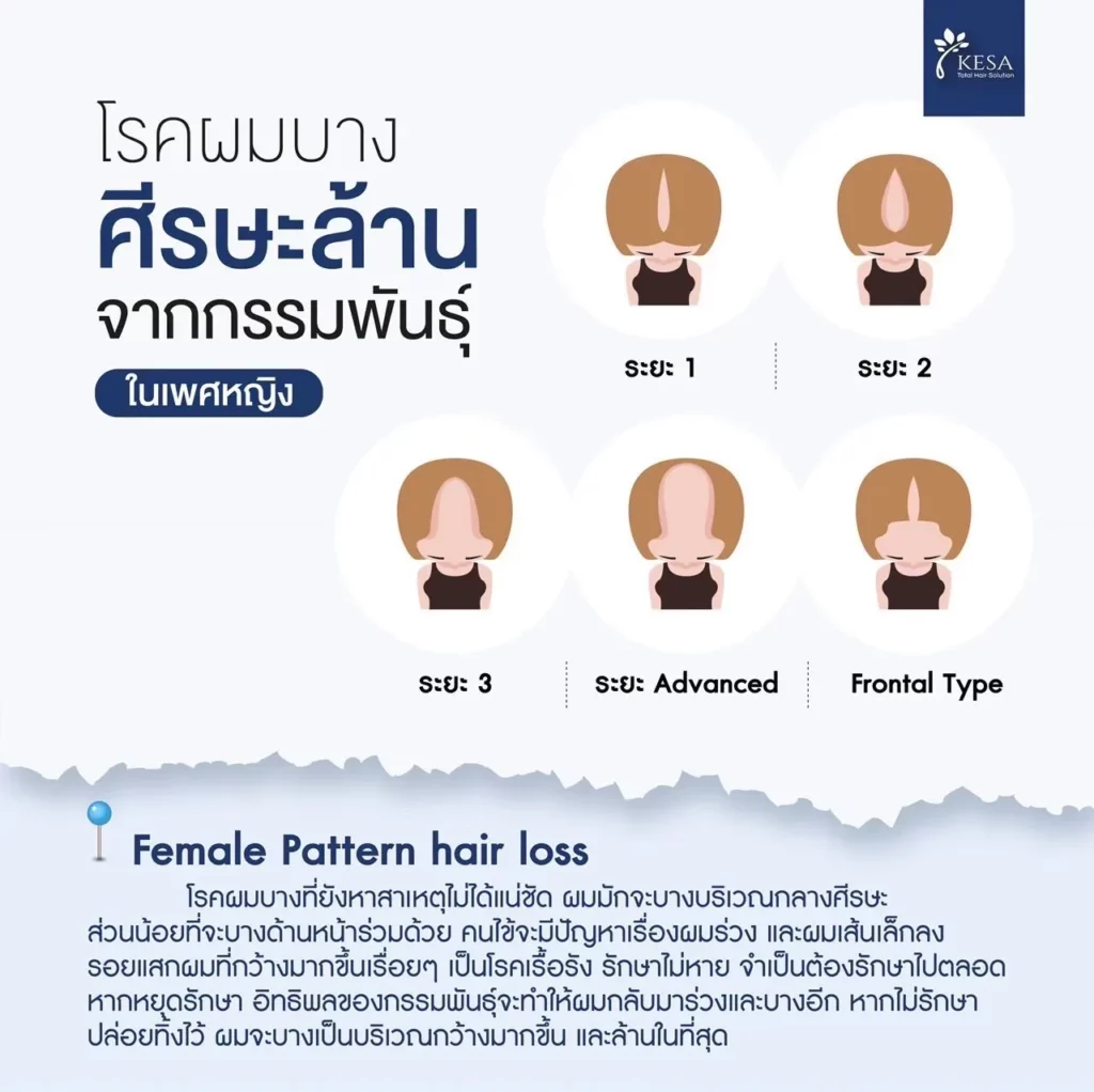 ผมบางผู้หญิง เกศา คลินิก - kesa hair clinic เกศา คลินิก - kesa hair clinic