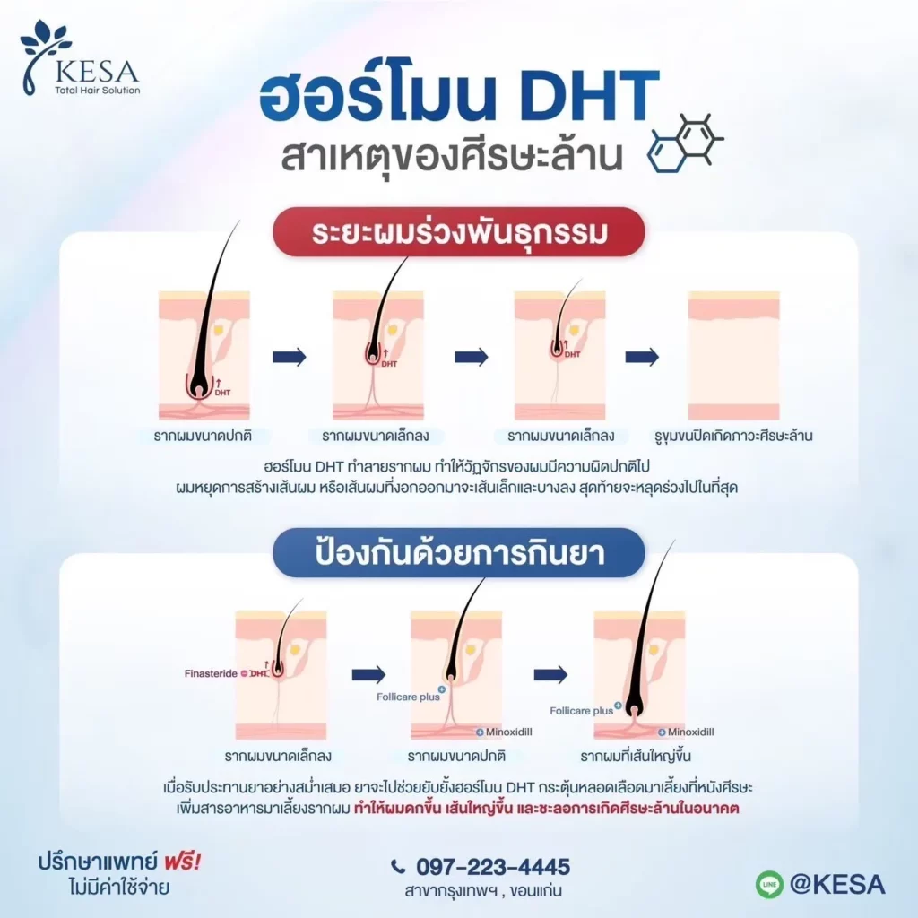 ผมร่วงบาง เกิดจากอะไร เกศา คลินิก - kesa hair clinic