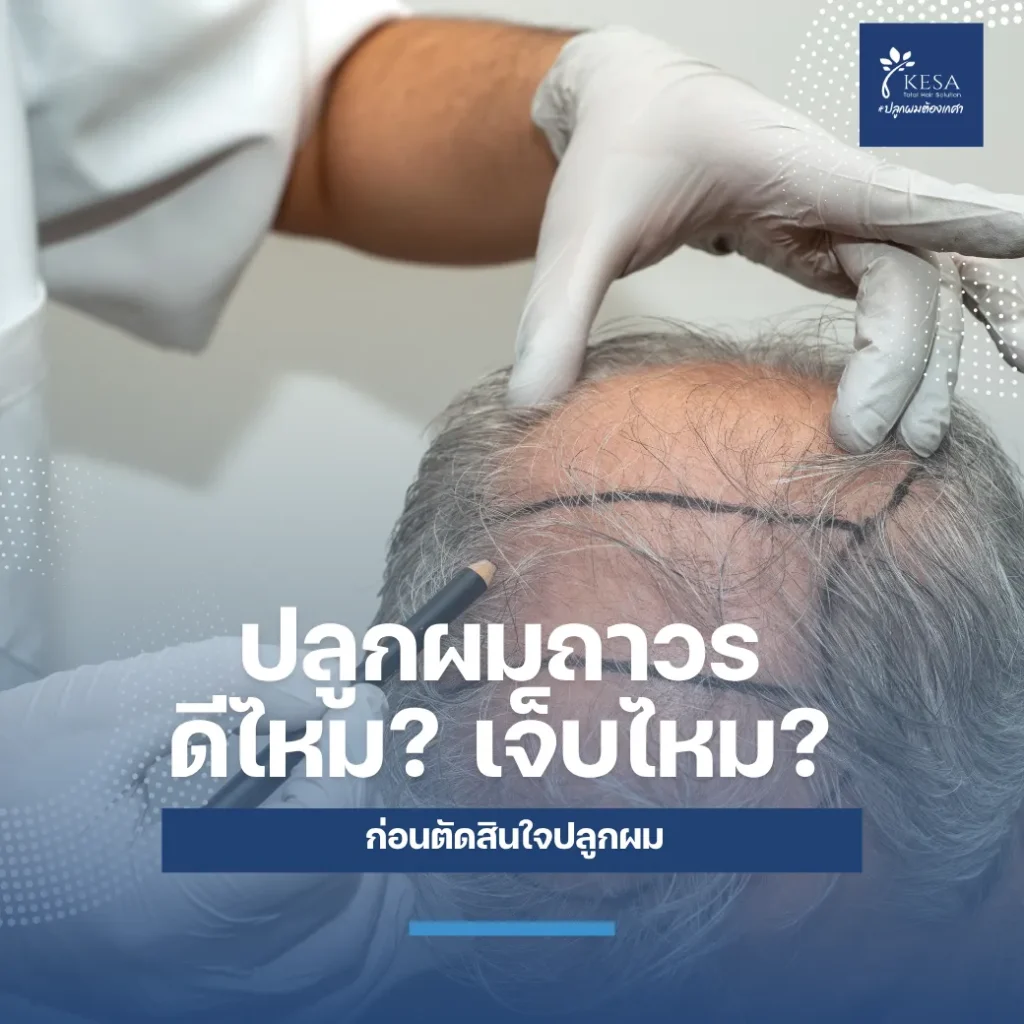 ปลูกผมถาวร ดีไหม? เจ็บไหม? ก่อนตัดสินใจปลูกผม เกศา คลินิก - kesa hair clinic เกศา คลินิก - kesa hair clinic